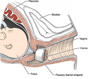 Prevenção da Prematuridade: Pessário Cervical